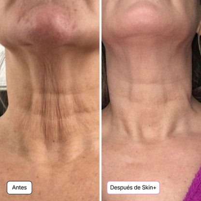 Micro-infusión coreana 5 en 1 - Resultados desde la 1.ª aplicación